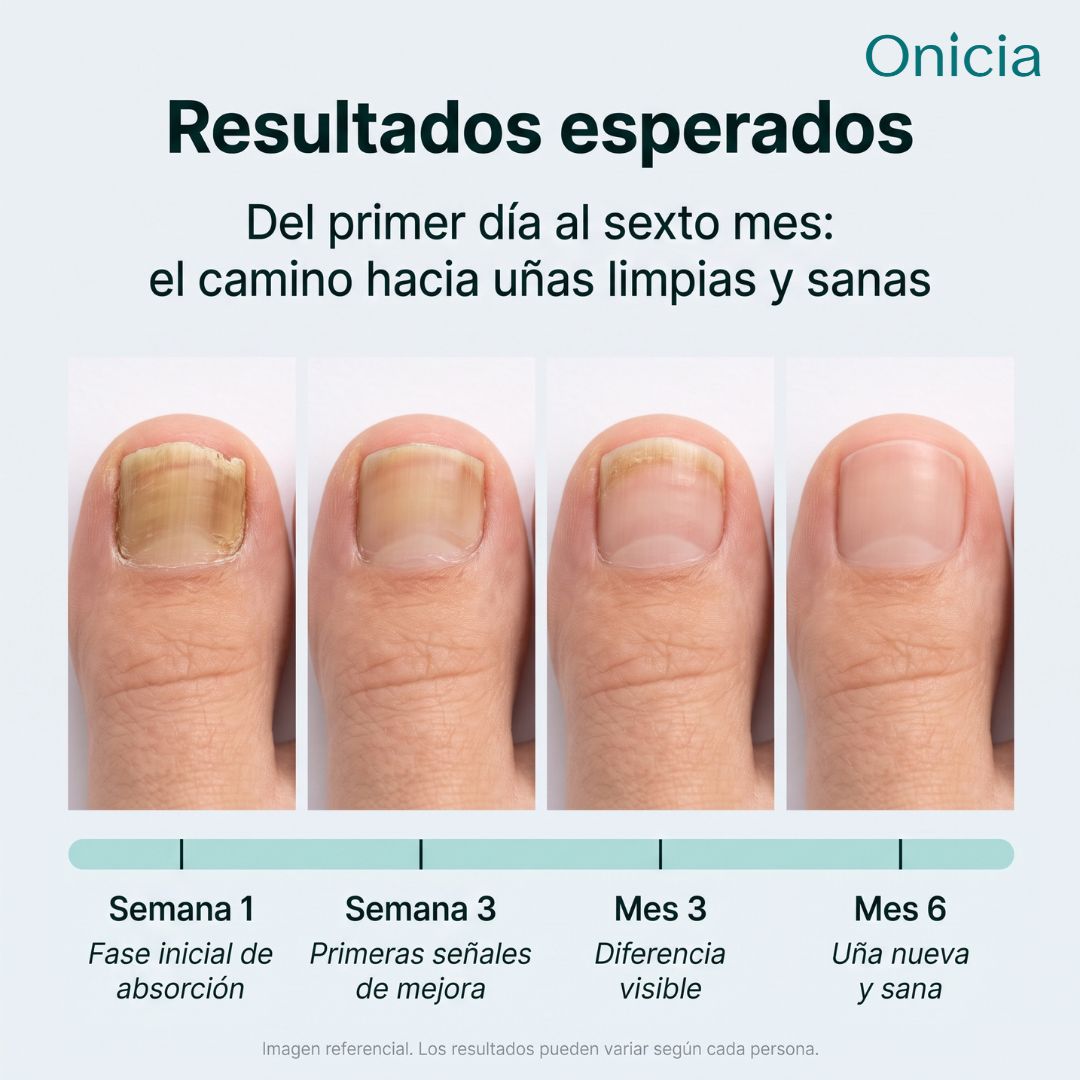 Lápiz Antifúngico Onicia – Para hongos en las uñas