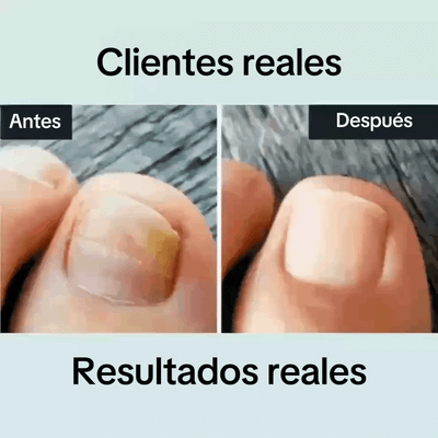 Lápiz Antifúngico Onicia – Para hongos en las uñas